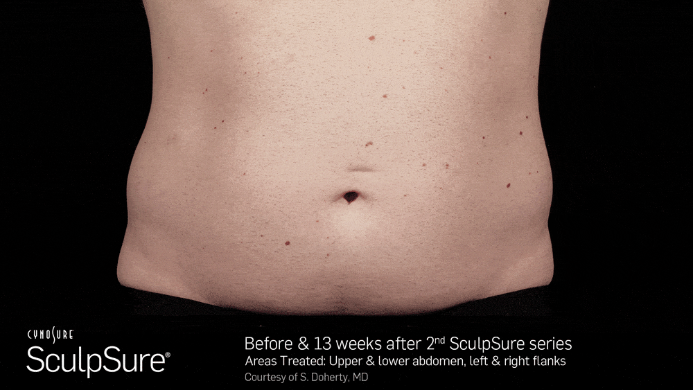 BA_Animated_SculpSure_S.Doherty_Core_2tx_13wks_13_compressed-min