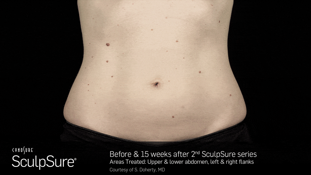 BA_Animated_SculpSure_S.Doherty_Core_2tx_15wks.01_compressed-min