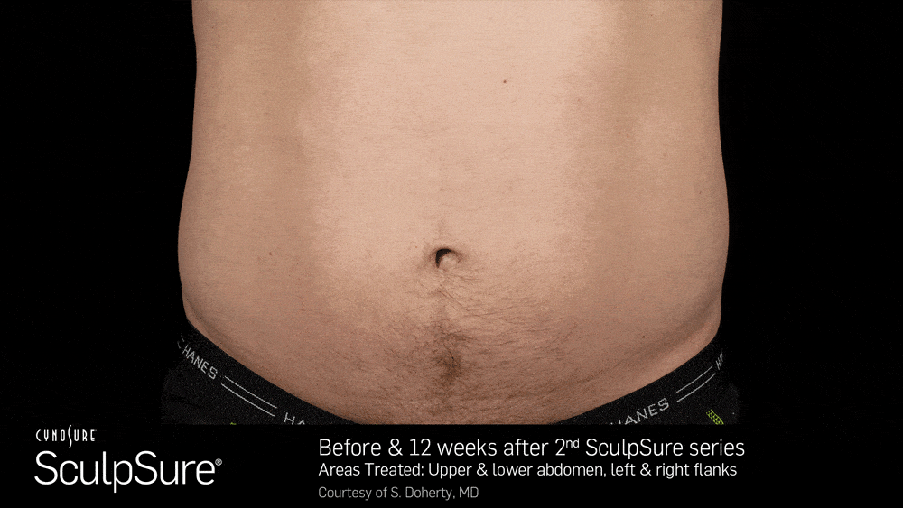 BA_SculpSure_S.Doherty_Core_2tx_12wks_02_compressed-min