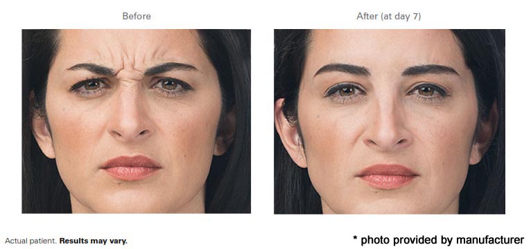 Botox-Before-After-4