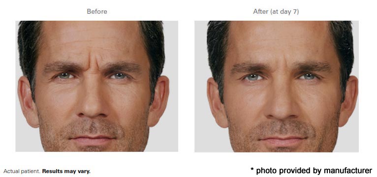 Botox-Before-After-5
