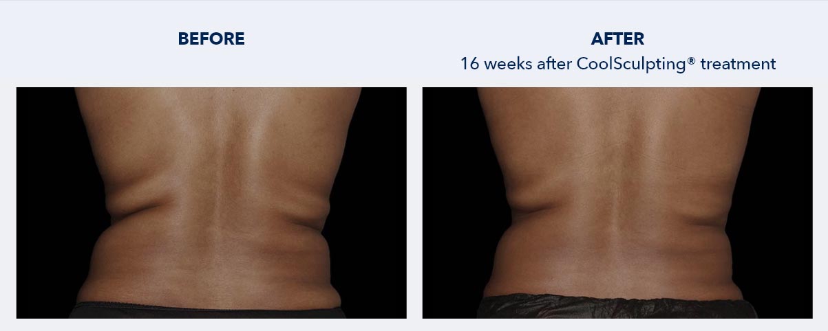 CoolSculpting Downtown San Francisco Fat Reduction and Body